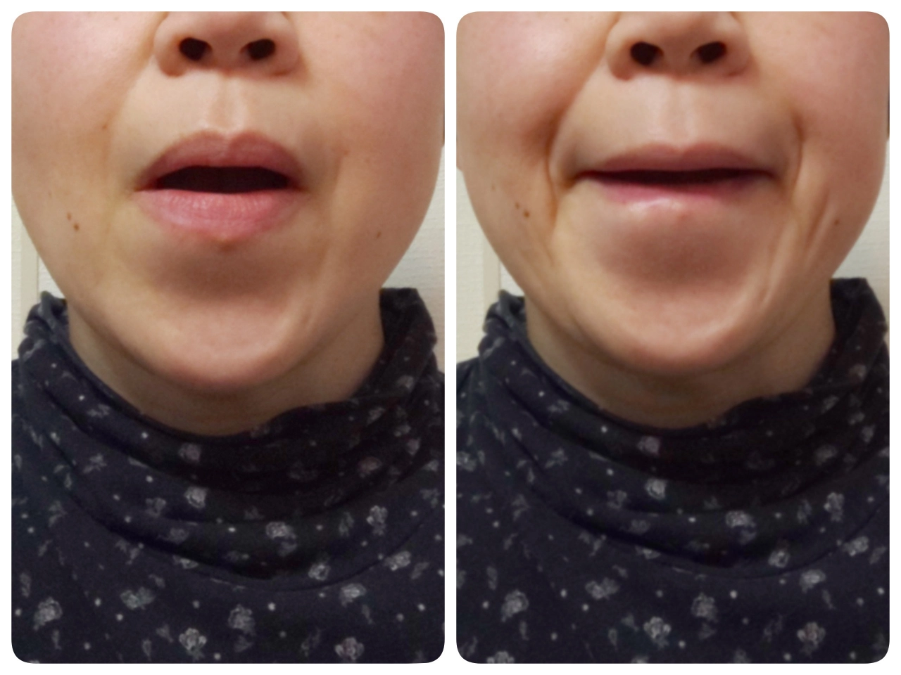 正面から見たあごの引き方の比較